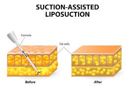 The Right Recovery Route After Liposuction